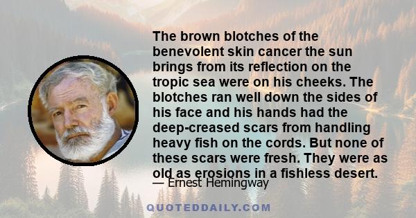 The brown blotches of the benevolent skin cancer the sun brings from its reflection on the tropic sea were on his cheeks. The blotches ran well down the sides of his face and his hands had the deep-creased scars from